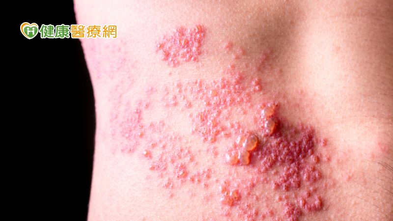 流感季來了! 口罩可防「流感、肺炎」 但「罩」不住「皮蛇」