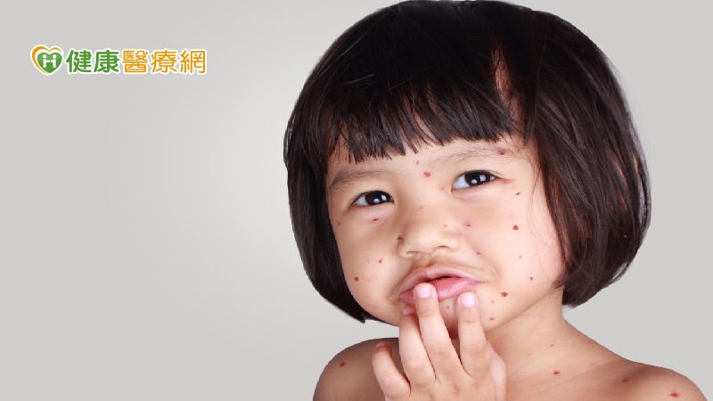 女嬰遭皮蛇爸傳染水痘 治療水痘施打疫苗最有效