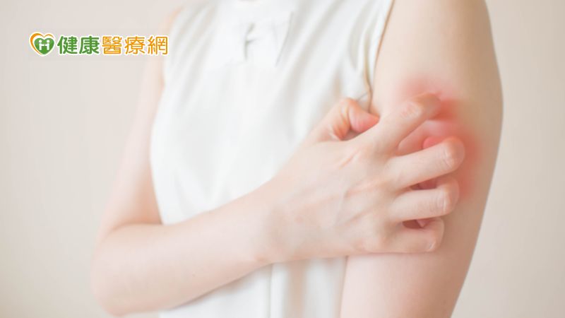 長期飽受中度至重度異位性皮膚炎困擾 生物製劑療法助一把