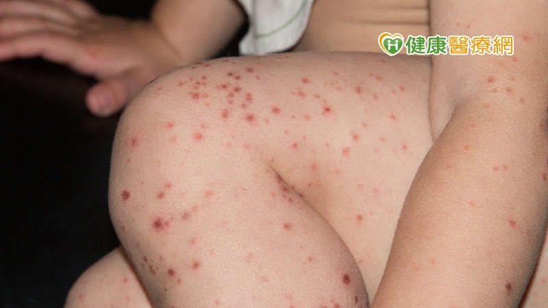 冬天仍須留意腸病毒威脅! 新增1例腸病毒併發重症