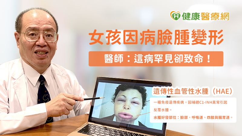 女孩因病臉腫變形 醫師:這病罕見卻致命!