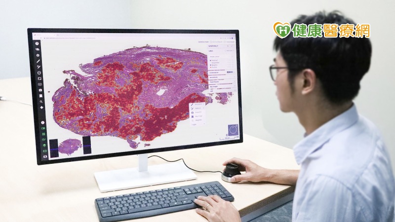 AI輔助判讀肺癌數位病理影像新突破 北醫大團隊研究登國際知名期刊