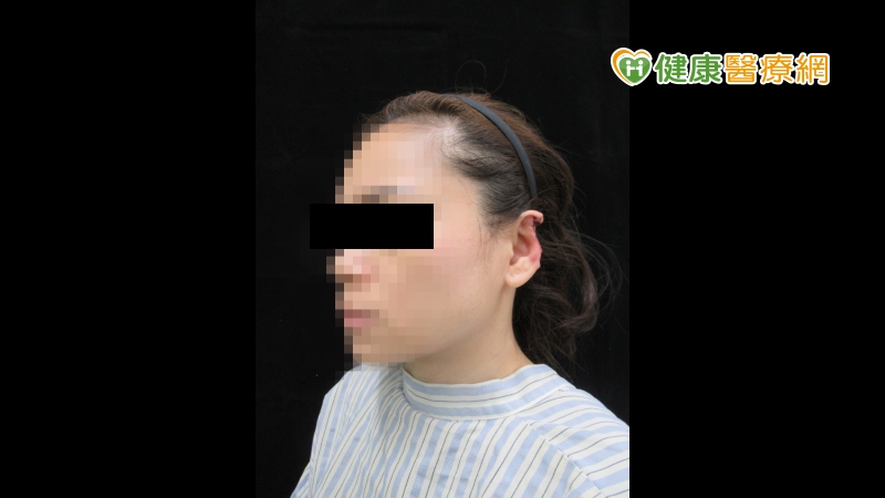 耳朵被人咬掉 整外醫師3次手術斷耳再造