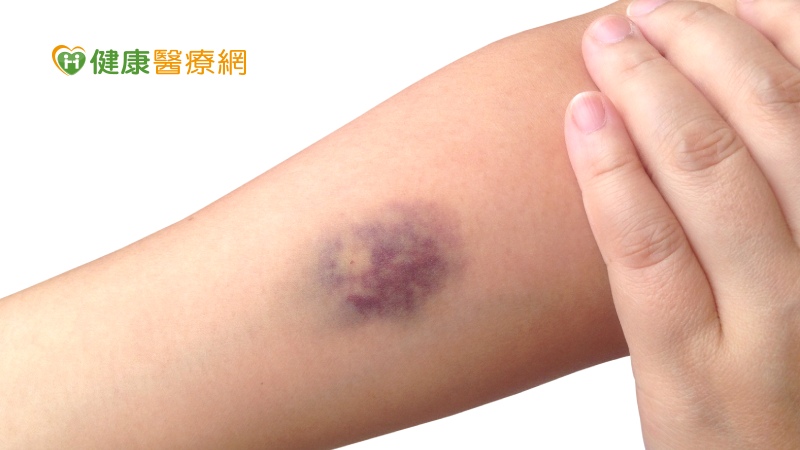 手腳忽然烏青、意識漸弱 竟然已經缺血性腦中風了