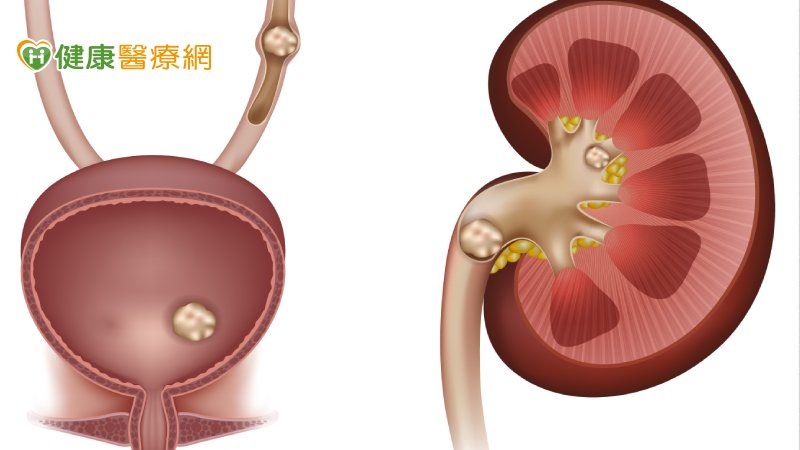 不會痛的結石最危險! 4種人對痛敏感度低恐 瀕臨洗腎