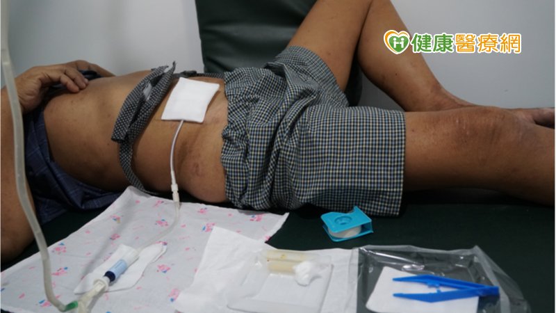 在家腹膜透析洗腎 減少出入醫療院所感染風險