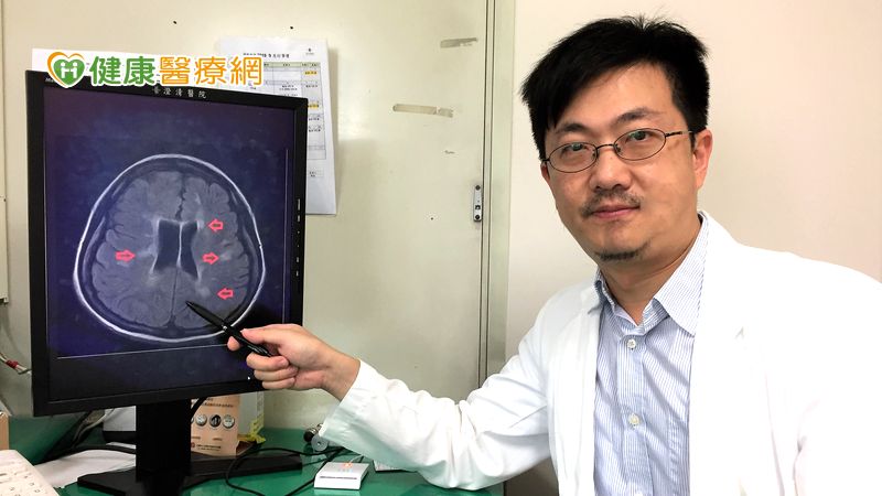 視力模糊、無力恐多發性硬化症? 健保藥物降5成復發率