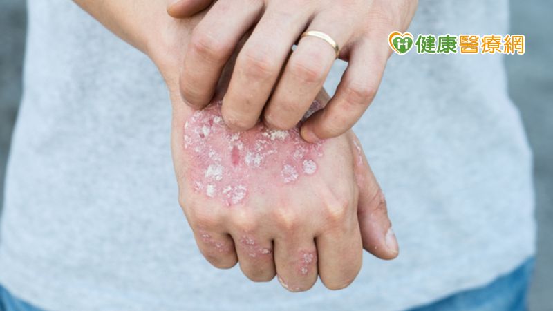 乾癬停藥易復發 健保新增「2年期滿續用」條款