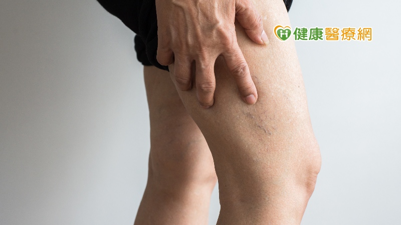 久坐族群注意! 嚴重靜脈曲張會致命