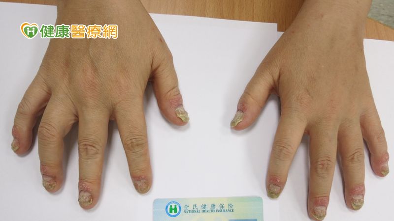 乾癬病友防關節炎小撇步 五大症狀要注意