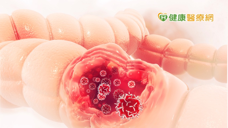 每年定期篩檢大腸癌 醫:有效降低三分之一發生率