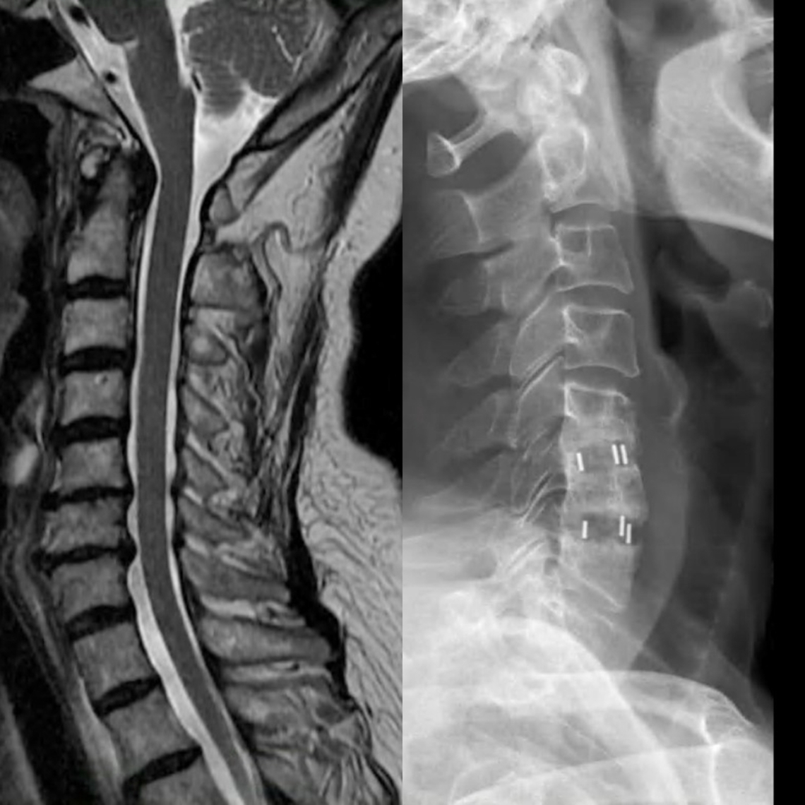 多年眩暈醫不好 元兇竟是頸椎退化 「交感型頸椎病」的患者