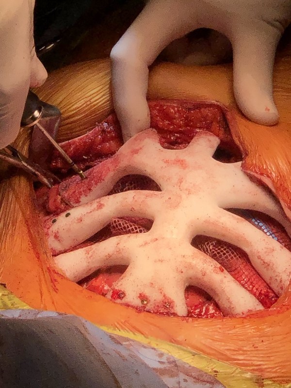 用螺釘將StarPore胸腔固定到位。 用螺釘將StarPore胸腔固定到位。