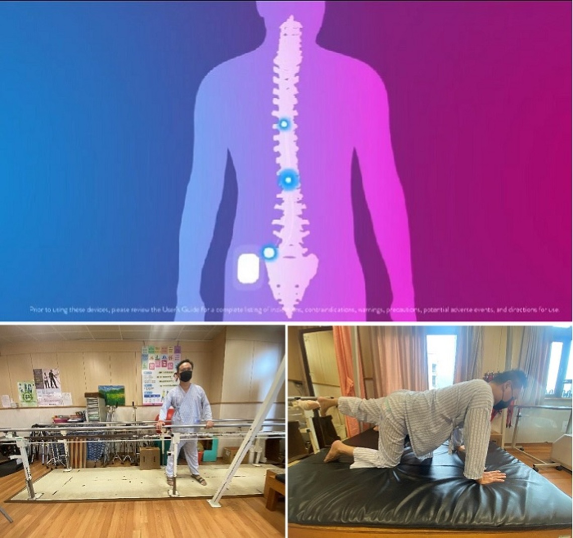 脊髓電刺激改善雙腿肌張力 病友恢復穩健步態