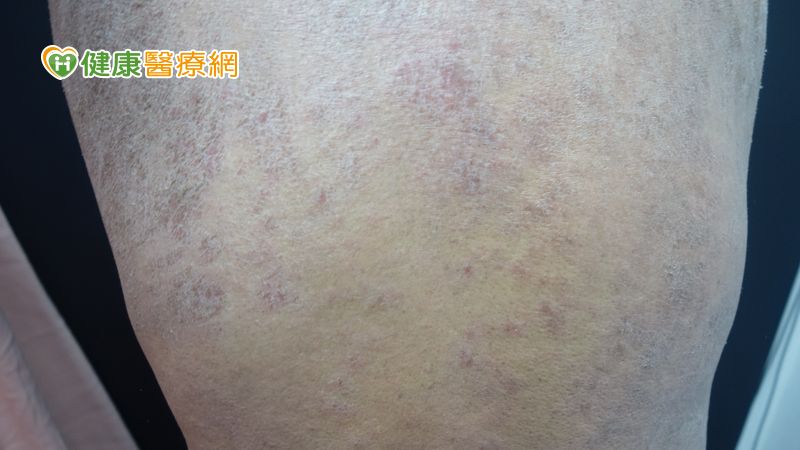 異膚冬季進補如提油救火!病友協會破除國人常見「五」大迷思