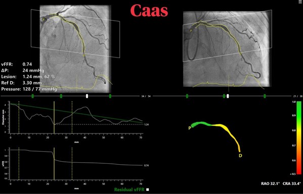 Pie Medical Imaging 的創新軟件「CAAS vFFR」用於中間冠狀動脈病變的非侵入性生理評估是 FAST III 的主題,這是一項歐洲多中心臨床試驗,將研究血管血流儲備分數 (vFFR) 引導的血運重建與傳統血流儲備分數引導的血運重建相比的有效性
