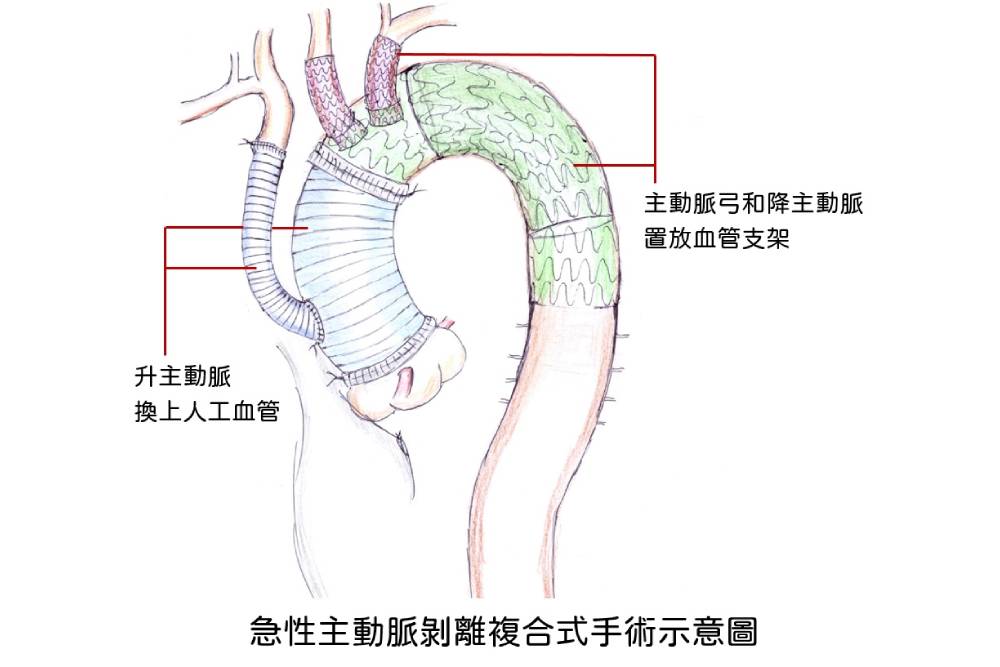 胖到主動脈剝離 工程師減重救命變型男 28 胖到-主動脈剝離-工程師-減重救命變型男