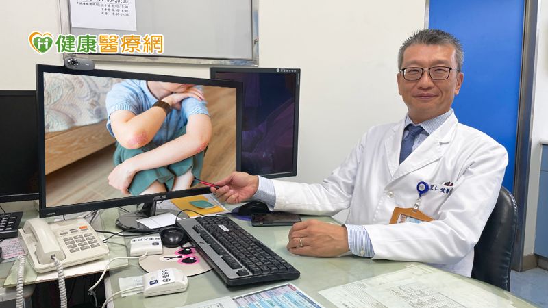 乾癬性關節炎纏身 模範生身心打擊竟拒學!
