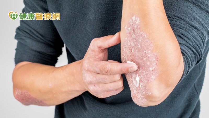 乾癬擦藥、吃藥沒改善? 生物製劑成治療新利器