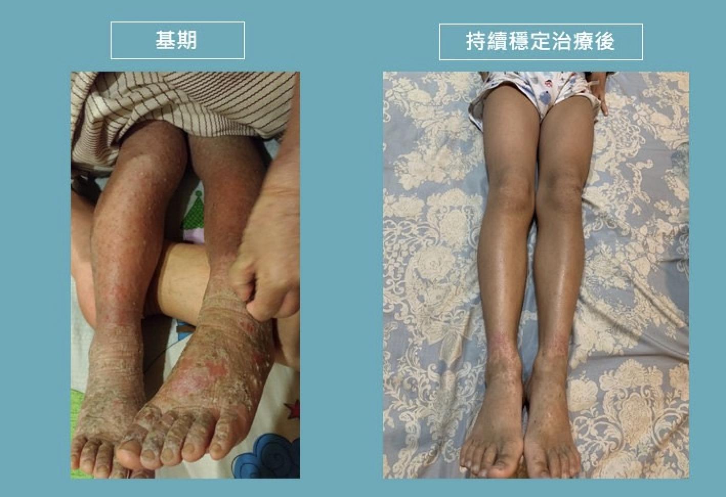 孩子「皮在癢」非小事! 8成病童恐走向氣喘、過敏性鼻炎得搶治療先機 12 截圖 2022 01 12 下午4.24.32