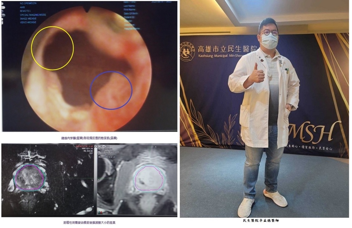 告別漏尿人生!! 增生療法 精準注射 改善攝護腺微創手術後遺症