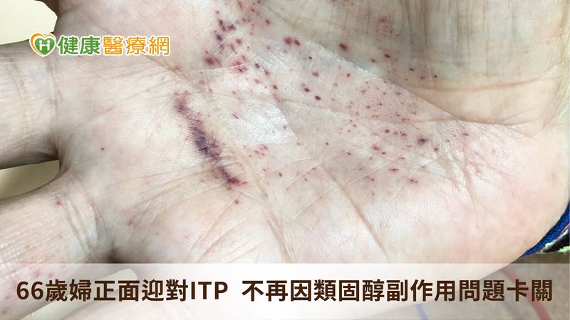 66歲婦正面迎對ITP 不再因類固醇副作用問題卡關