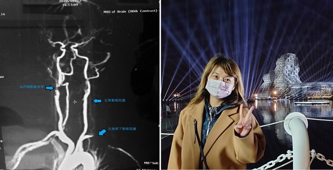 頭向左轉就昏倒!  民生醫院曾靜娟主任抓出元兇竟是「弓箭手症候群」作祟