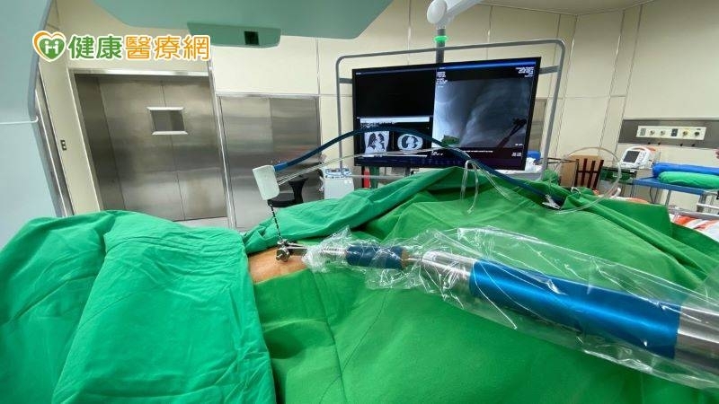肺癌治療新里程 「一站式」無創微波消融手術保肺