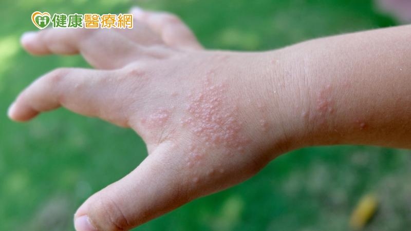 富貴手、汗皰疹纏身 醫:「三不」良方解決手部濕疹