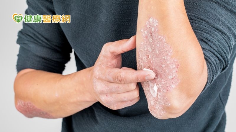 乾癬保養秘技大公開! 皮膚症狀與共病管理缺一不可
