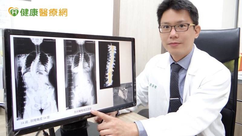 青少年脊椎側彎應定期追蹤 避免症狀惡化