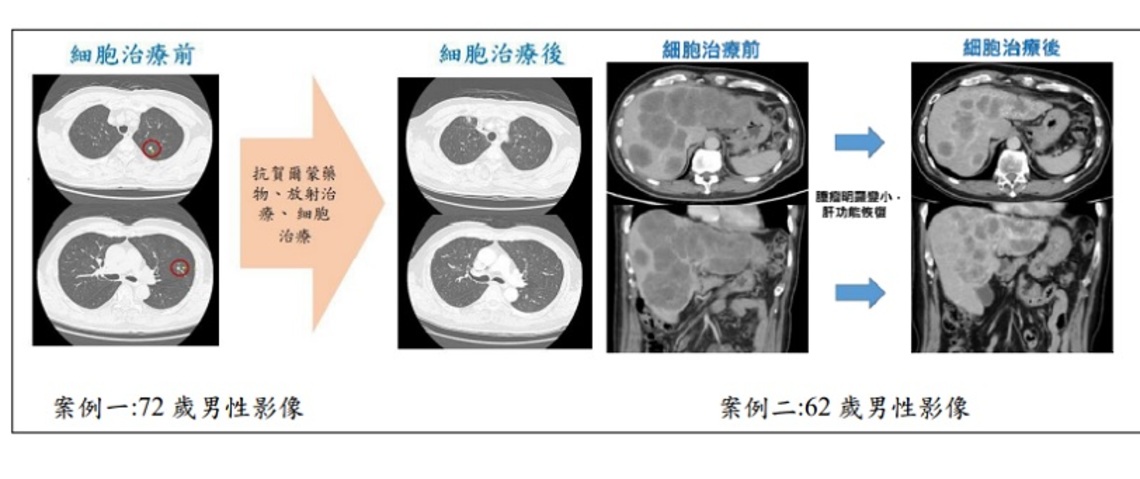長聖 Gamma Delta-T 細胞    第一家獲衛福部核准之新型細胞治療