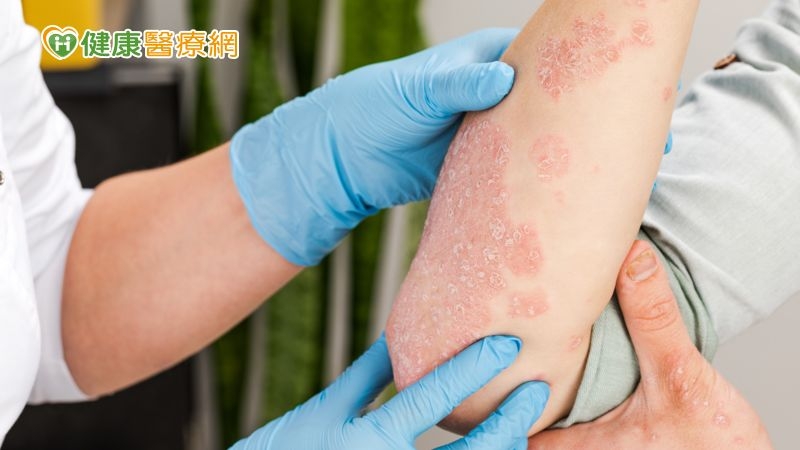 乾癬症狀越顧越遭? 治療3大關鍵報你知