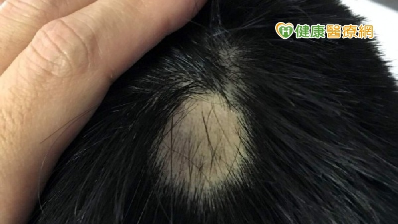 威爾史密斯不滿妻落髮遭調侃而揮拳 圓禿會好嗎?