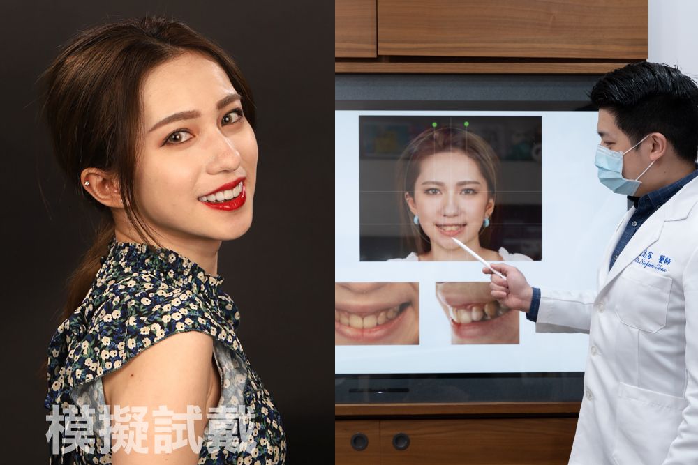 【有影】數位全口掃描+試戴3D列印模型 訂做完美全瓷牙冠不再心驚驚 16 模擬試戴
