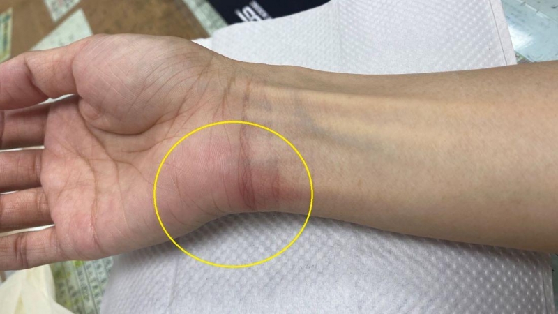 周末防疫在家料理手工丸 引發肌腱炎痛到飆淚