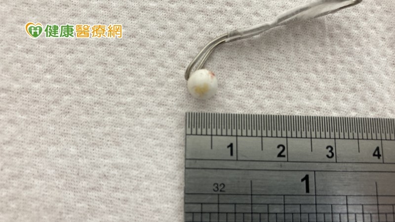 4歲童BB彈塞耳朵 醫籲勿急自掏