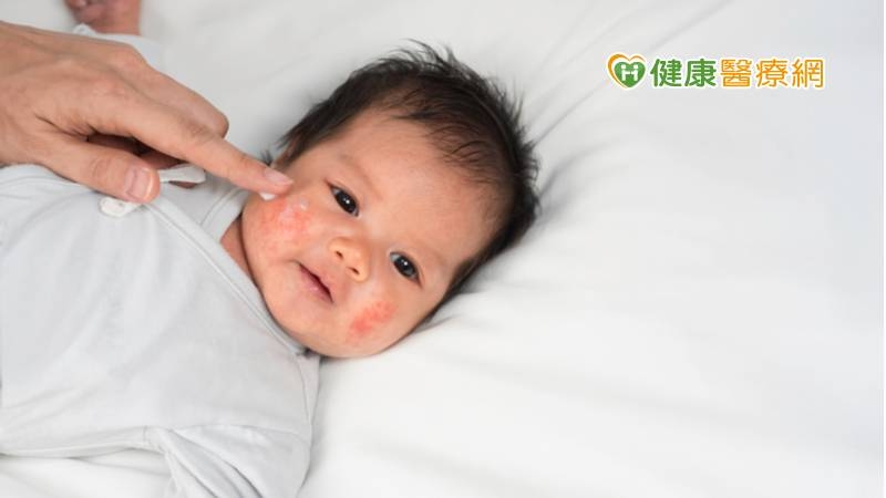 異位皮膚真困擾 精準治療阻過敏