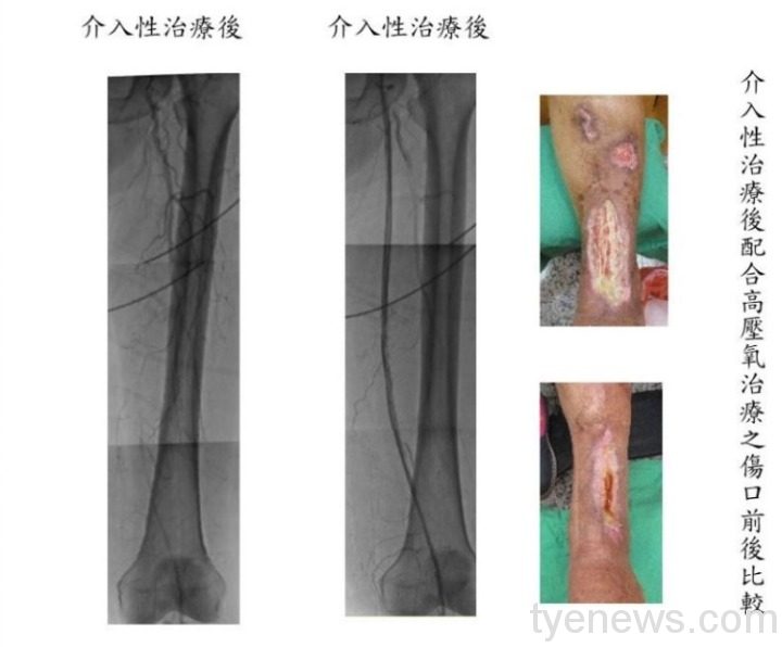 嚴重周邊動脈阻塞性疾病 控制阻塞危險因子避免截肢 16 傷口前後比較2