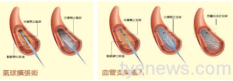嚴重周邊動脈阻塞性疾病 控制阻塞危險因子避免截肢 17 洪國峻醫師新聞稿