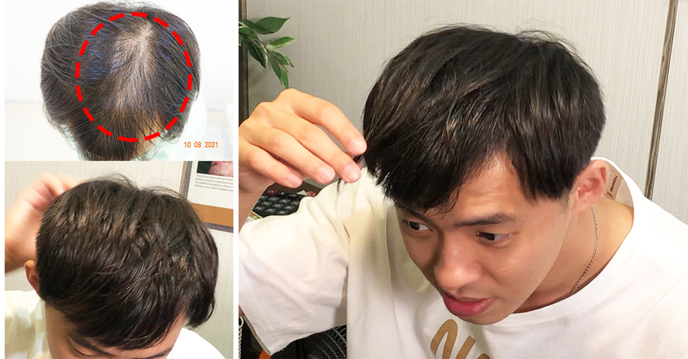 ▲植髮1500根術後半年,中頂髮密度不再空虛。(圖/高地植髮家診所提供)