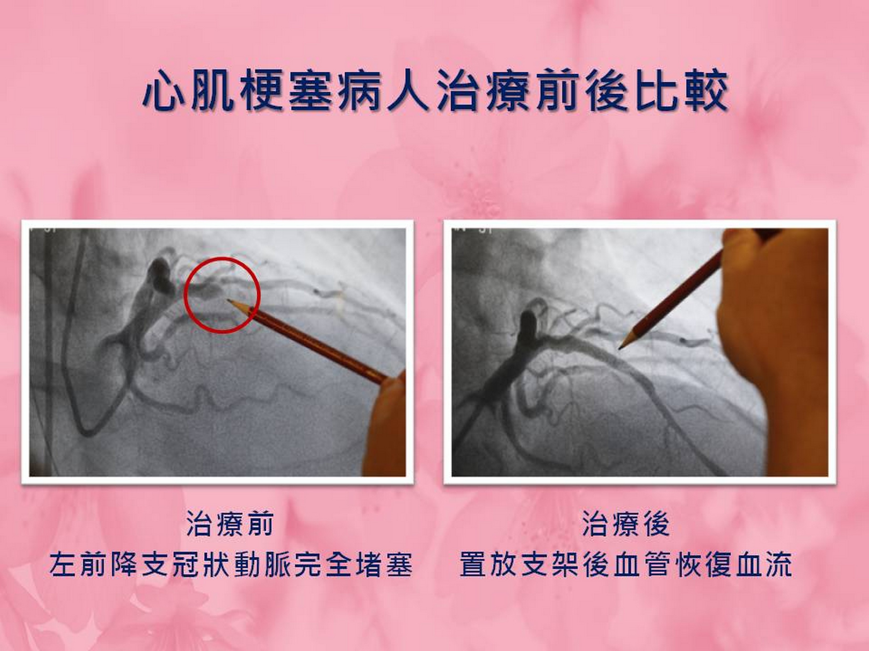 心梗肌塞病人治療前後比較。