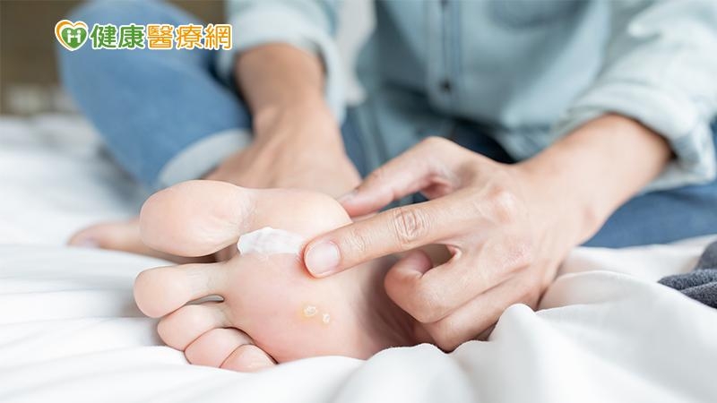 梅雨讓你「香港腳」復發了嗎?醫師:康復後繼續擦藥1~2週