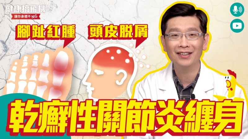 頭皮脫屑腳趾腫如香腸 竟是乾癬性關節炎纏身