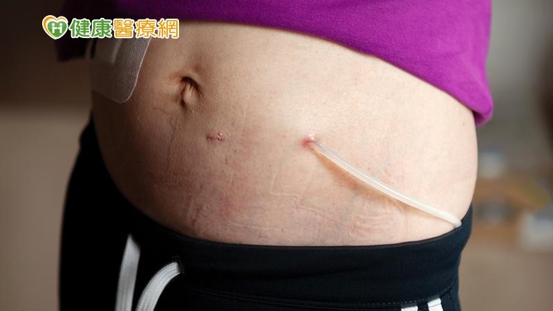 【洗腎專題】生、心理雙重煎熬!腎友協會籲:別吝嗇尋求協助