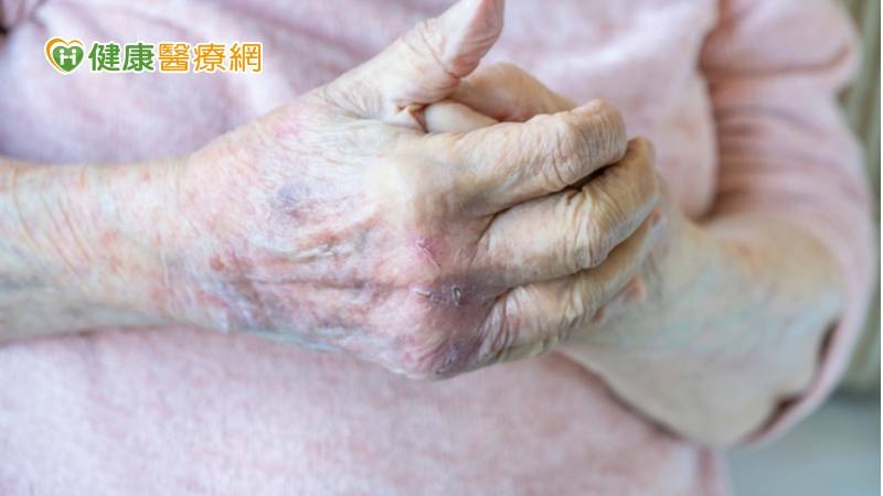 梅雨季皮膚癢加重 可能是汗皰疹作怪