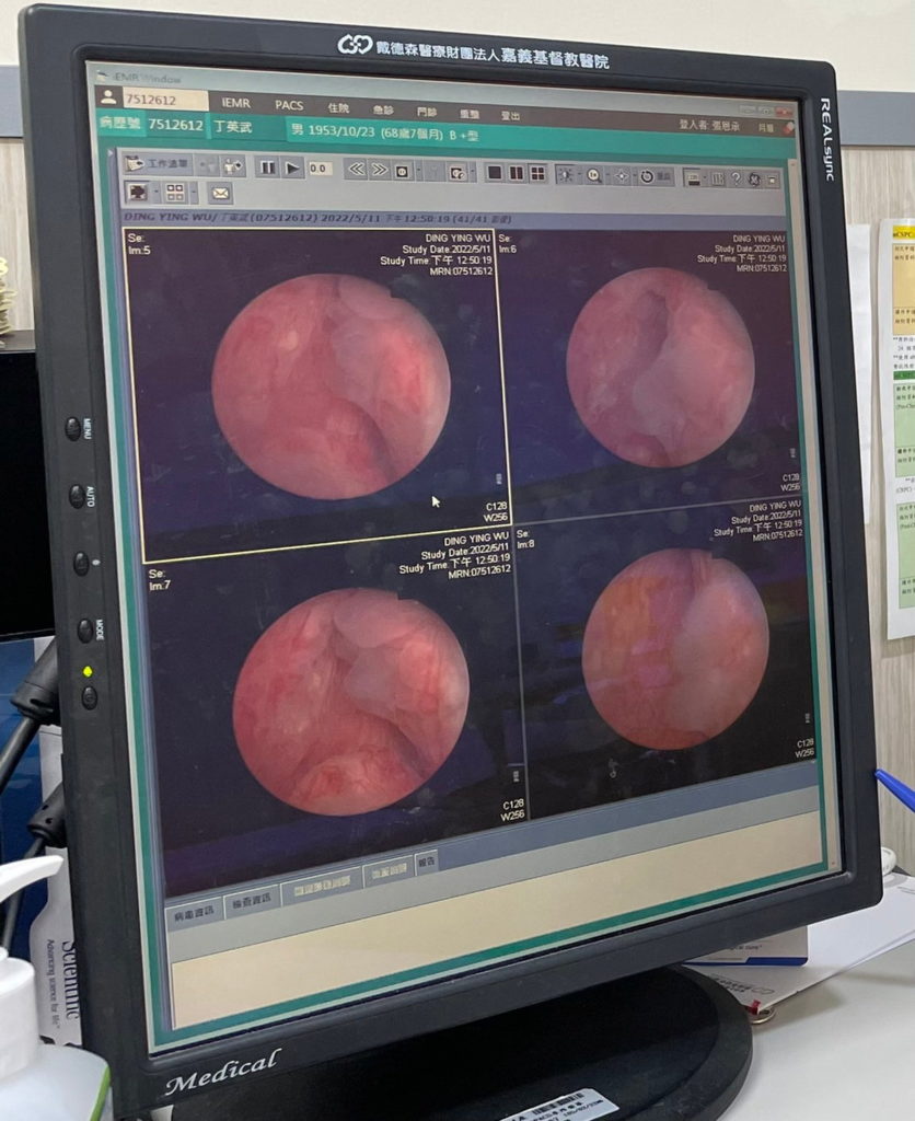 攝護腺肥大