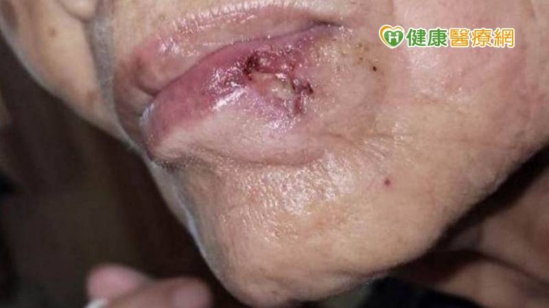 突然長「痣」莫輕忽 當心皮膚癌
