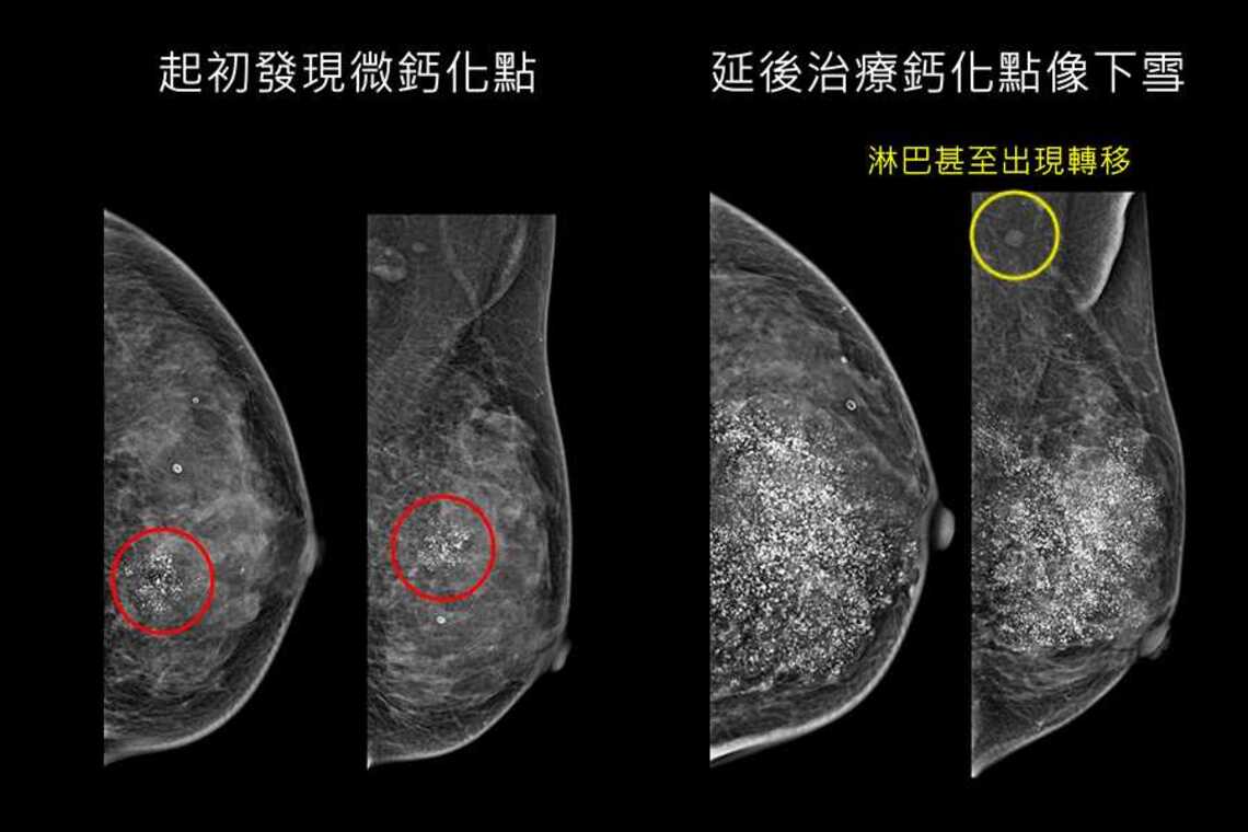 罹癌延後治療兩年 乳房鈣化點彷彿下起大雪