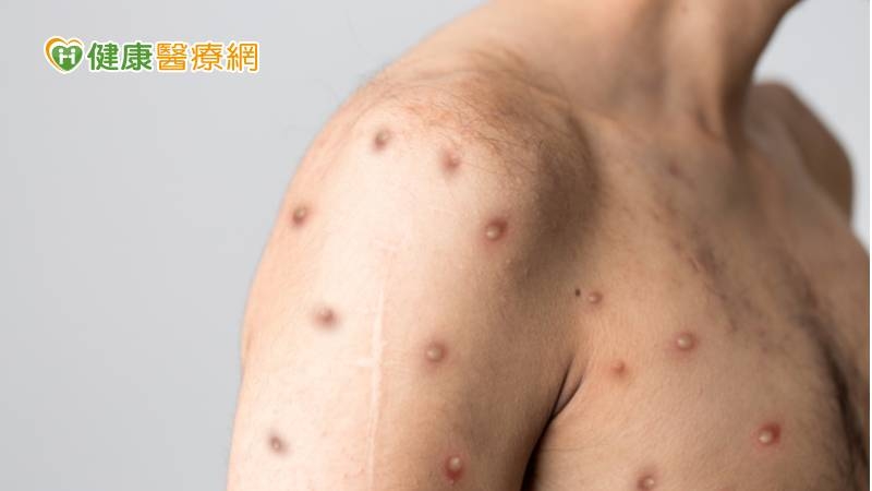 國內驚見首例猴痘 醫授2招預防感染